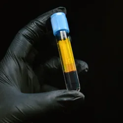 Bioestimulación con plasma rico en Plaquetas ( PRP)