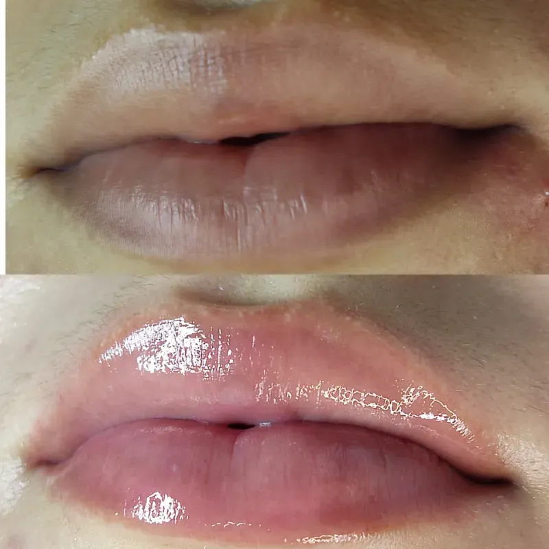 Hidra lux lips