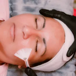 Peeling Químico.