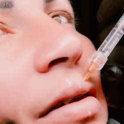 Relleno de labios/ surcos nasogenianos/ pómulos.