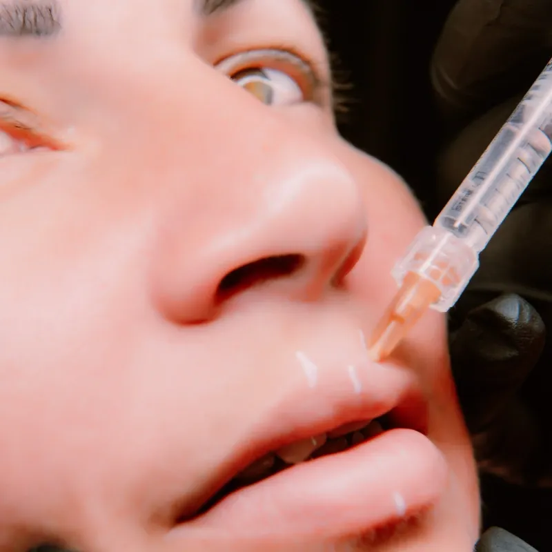 Relleno de labios/ surcos nasogenianos/ pómulos.