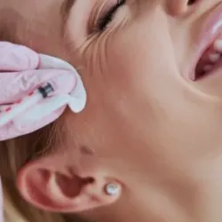 Corrección de arrugas patas de gallo