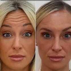 Corrección de arrugas frontales