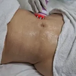 Radiofrecuencia en abdomen