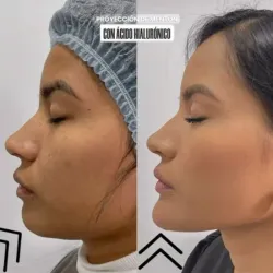 Proyección del mentón