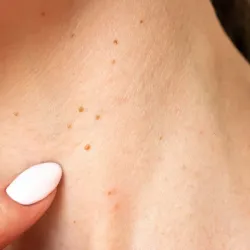 Eliminación de verrugas