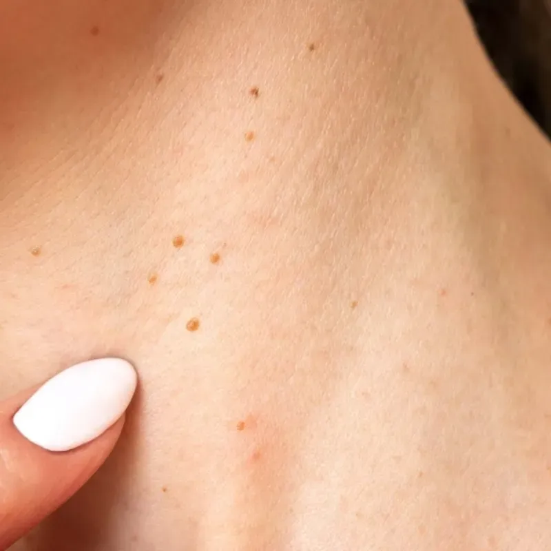 Eliminación de verrugas