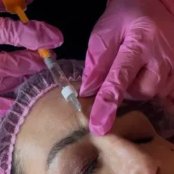 Corrección de arrugas glabelares