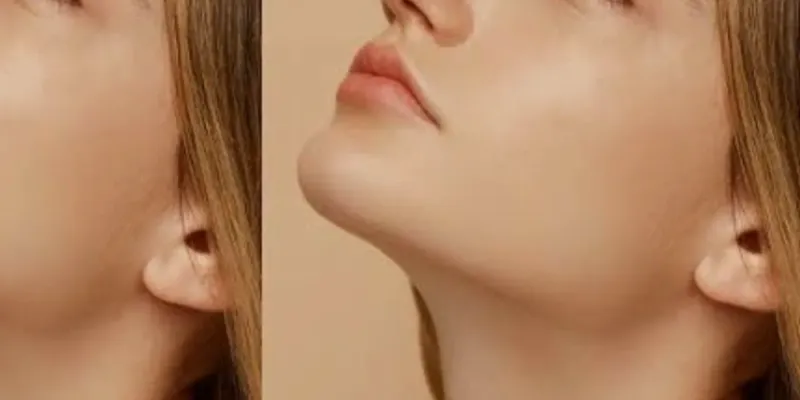 Perfilado o marcaje mandíbular