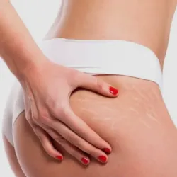 Tratamiento de estrías localizadas 