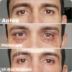 Blefaroplastia completa no quirúrgica con Fibroblast