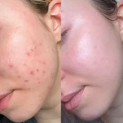 Limpieza Facial Profunda + Tratamiento Anti-Acné