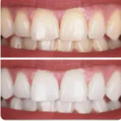 Blanqueamiento bucal 