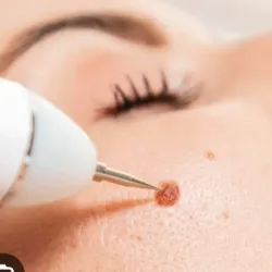 Eliminación de verrugas 