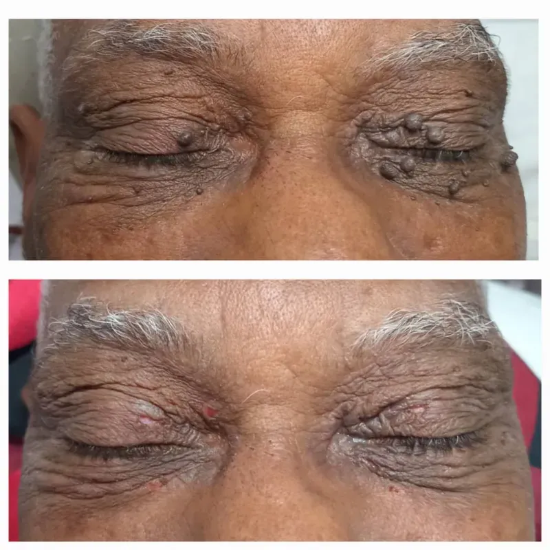 Eliminación de verrugas 