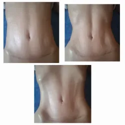 Masaje Post Operatorio ( Cuerpo entero)