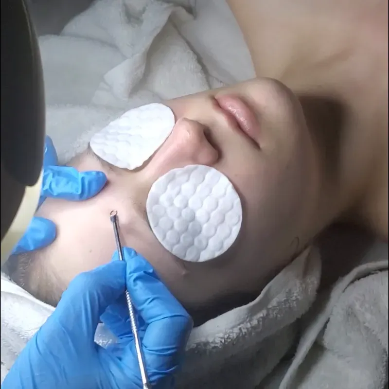 Limpieza facial profunda 