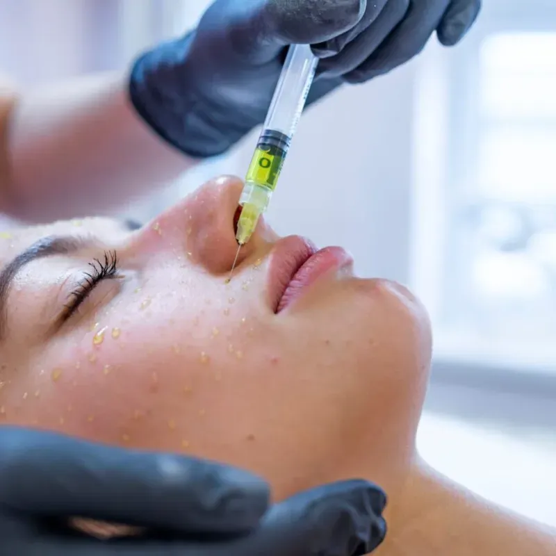 Mesoterapia  con bioactivos (ácido hialurónico  y encimas Q y oliogoelementos)