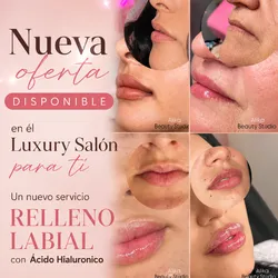 Relleno Labial con Ácido Hialuronico